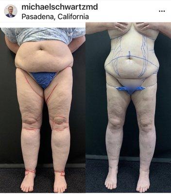 Lipedema: before and after Vaser liposuction for lipedema