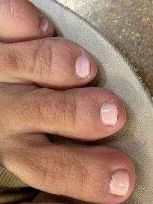 Poor pedicure