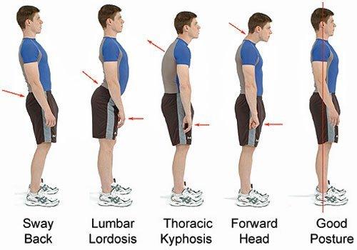 Types of Bad Posture