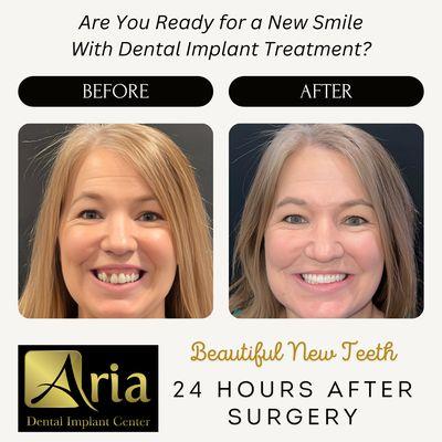 24 hours after surgery you will receive your new set of teeth.