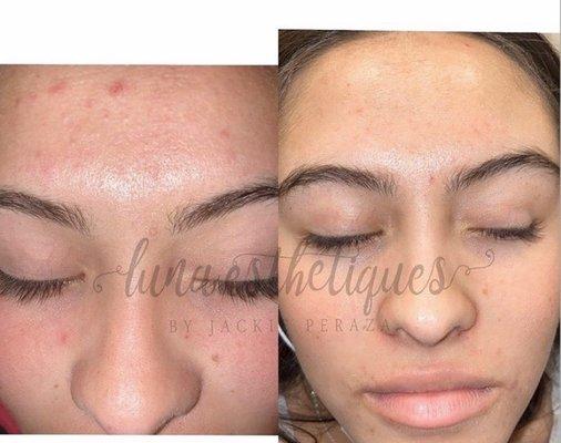 Acne Facial by Jackie