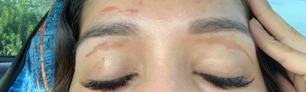 Burns from eyebrow waxing