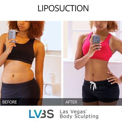 Liposuction - Before & After