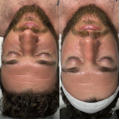 Before & after hydrating facial