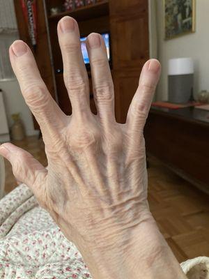 Right hand is used the most in old age and hurts more. 08/09/24