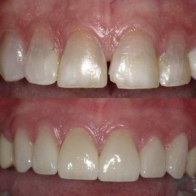 Smile Transformation Before and After- Dr. Thomas Dooley Cedar Village Dentistry