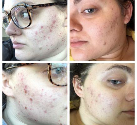 Before and After Acne Treatment