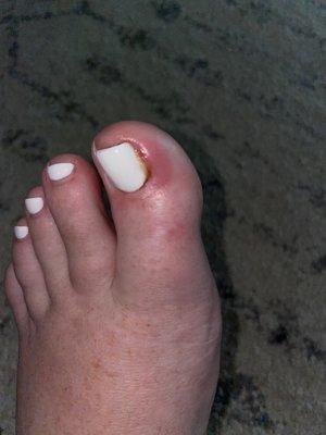 Infected toe nail