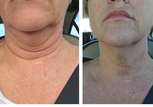 Kybella treatment dissolves fat forever! For more info on Kybella call Joules Medspa.