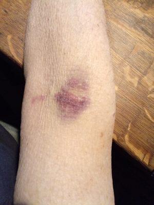 Caused by what appeared to be an unidentified  student who attempted to draw my blood at Quest.