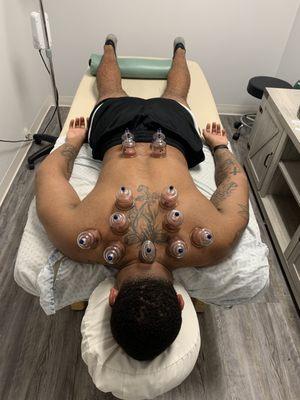 cupping