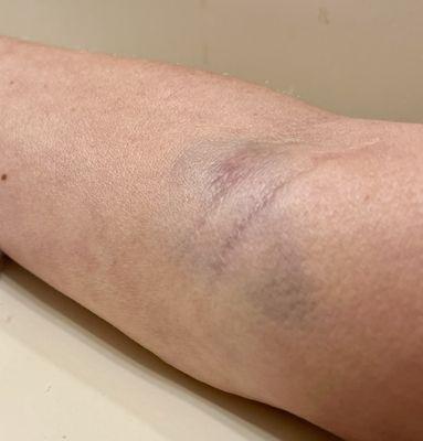 My bruised arm the next day after blood draw.