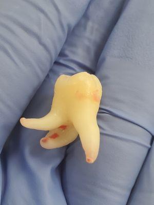 Wisdom tooth extraction