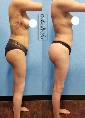 Rt: Progress photo. 1st photo post bbl & lipo. 2nd photo after 3 MLD sessions