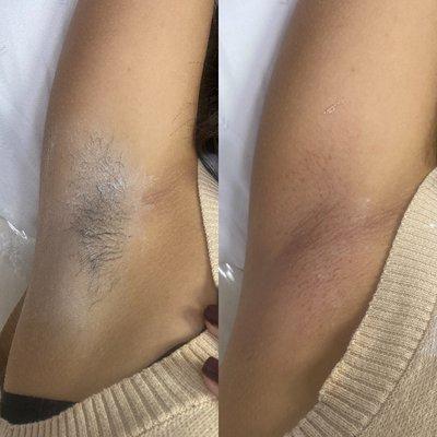 before and after an underarm wax