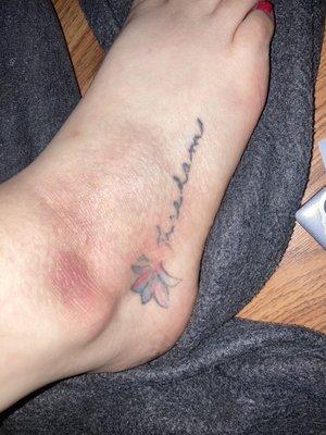 Bruise foot