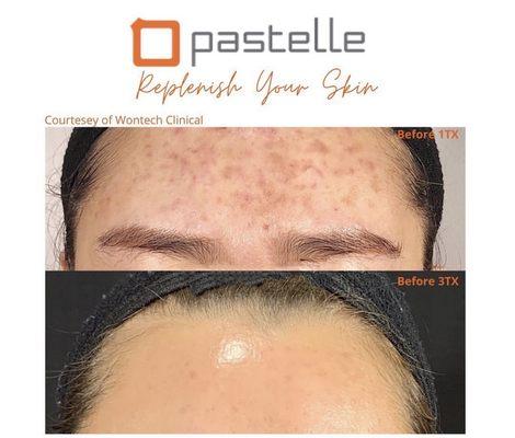 Pigmentation removal