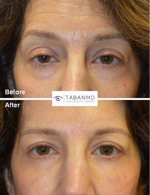 Middle age female, with tired-old looking eyes, had cosmetic eyelid procedures: lower + upper blepharoplasty, & droopy eyelid (ptosis) surg.