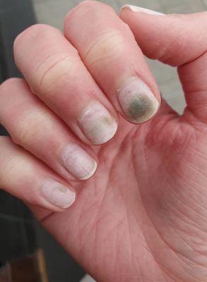 FUNGUS ON NAILS