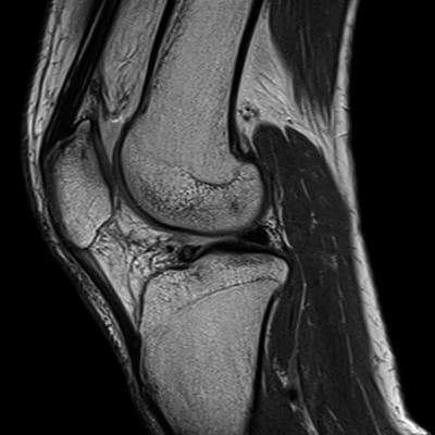 MRI Knee