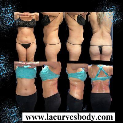 Body contouring