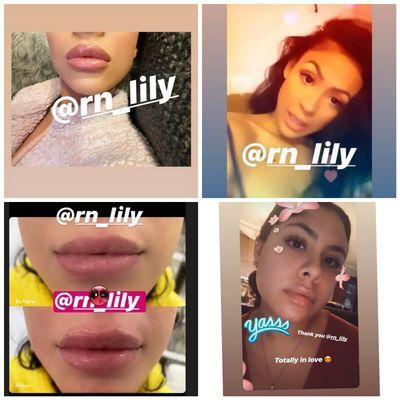 Happy clients after getting lip fillers done