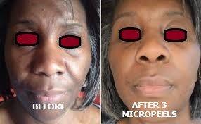 BEFORE AND AFTER 3 MICROPEELS