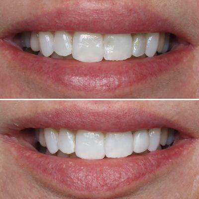 Some 1 visit bonding to achieve a more cohesive smile profile. Sometimes a little bit goes a long way :)