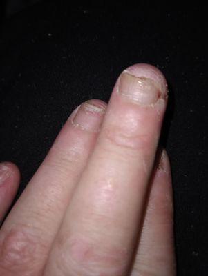 This is what they did to my nails. This is what they look like when they came off it should have never looked like this