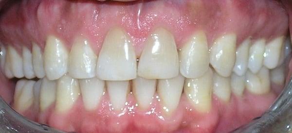 Invisalign Patient G After