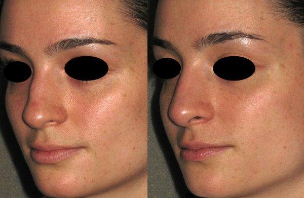 Non-surgical Nose Job