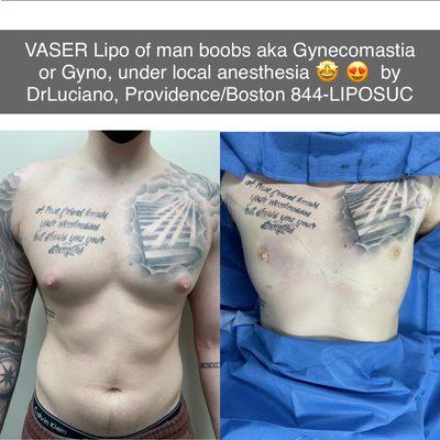 Man boobs aka Gyno or Gynecomastia, under local anesthesia!