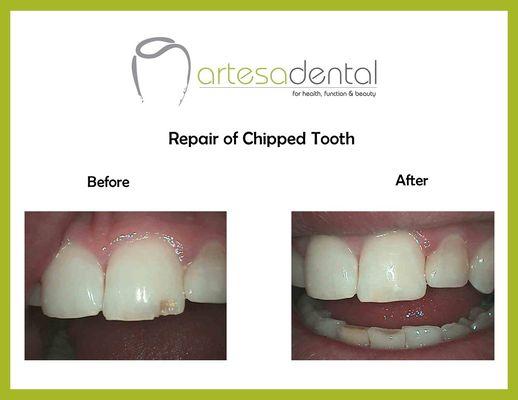 Chipped front tooth? No problem! We can repair it in under an hour.