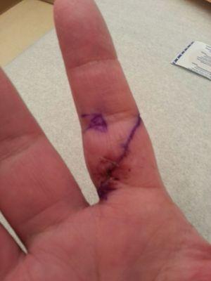 Bandages off - purple line is the surgery guide for doctors.