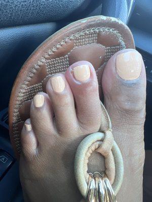 Pedicure, picture two, showing the toe infection I got afterwards from rough cuticle cutting where my skin was cut.