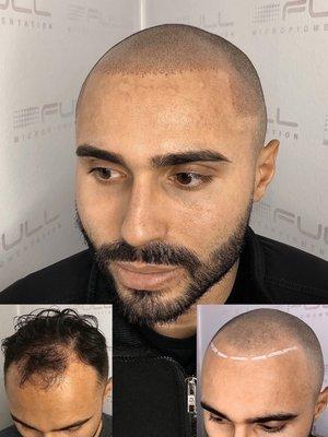 Scalp Micro Pigmentation