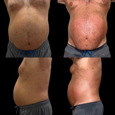 Two treatments of our Ultrasonic cavitation. Fat bursting & skin tightening