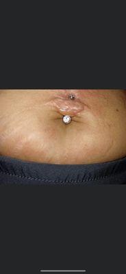 Botched belly button piercing