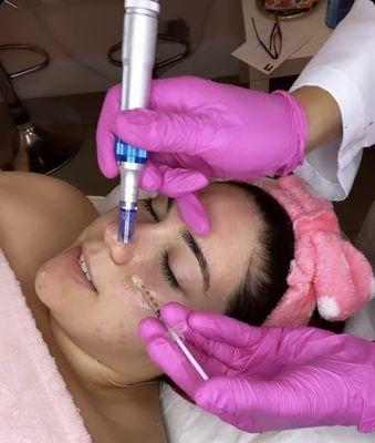 PRP FACIAL