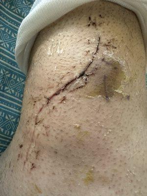 Surgery scares after 2 weeks