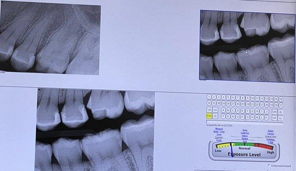 Heres at the fillings Dr. Sarafyan performed