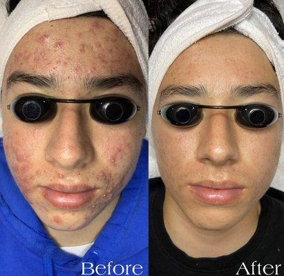 2 months process with our acne corrective treatments.