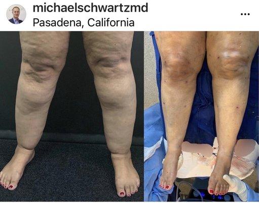 Lipedema legs before and after liposuction