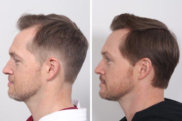 1 year after hair transplant (FUE) by Dr. Benjamin Paul.