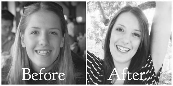 My smile before and after. Thank you Dr. Bishay for the amazing work!