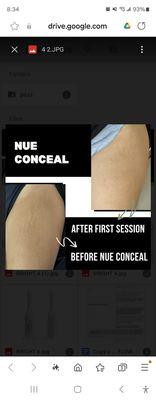 Nue Conceal scar therapy