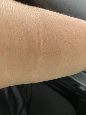 Marks on arm from elastic band!