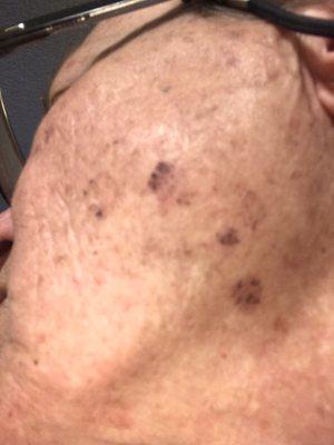 With one treatment, the spots turn dark for 2-3 weeks before fading.