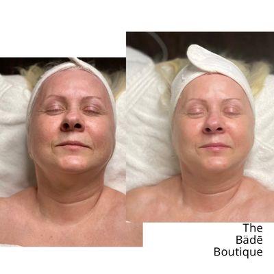 The Diamond Facial is the ultimate anti-aging treatment. Brighten, Firm and balance your skin back to it's vibrant, youthful state