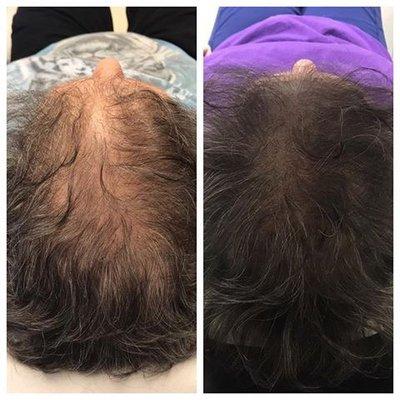 Scalp Micropigmentation

Before and after of SMP
Tattooed by Bobbi Jo